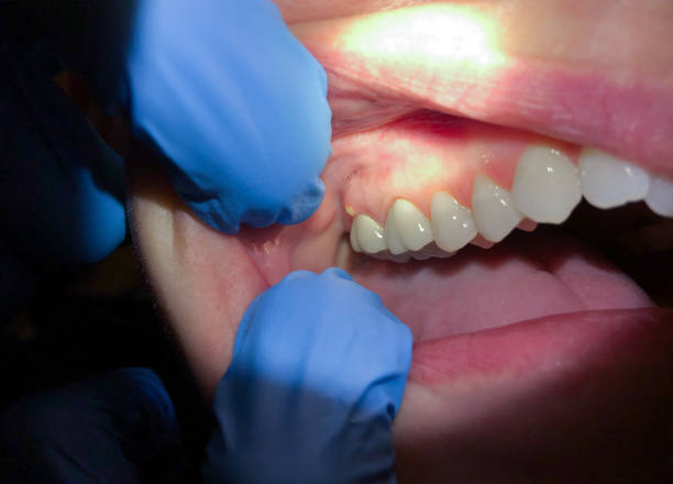 Best Emergency Cosmetic Dentistry (e.g., broken veneers) in Port Barre, LA